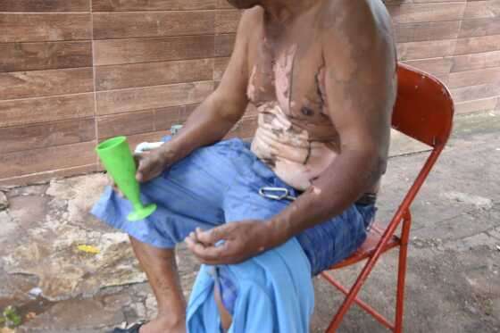 Homem queimado