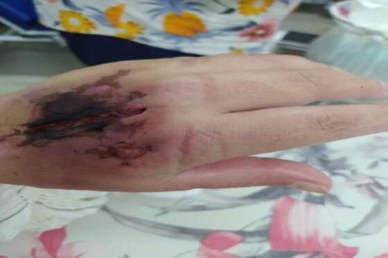 TUMOR