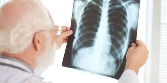 Tuberculose