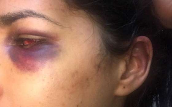Agressão - olhos roxo