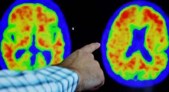 reuters-doenca-de-alzheimer-exame-de-imagem-cerebro-1500-30072023144053848.jpeg