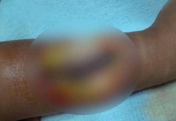 Criança teve parte do braço necrosada após injeção.