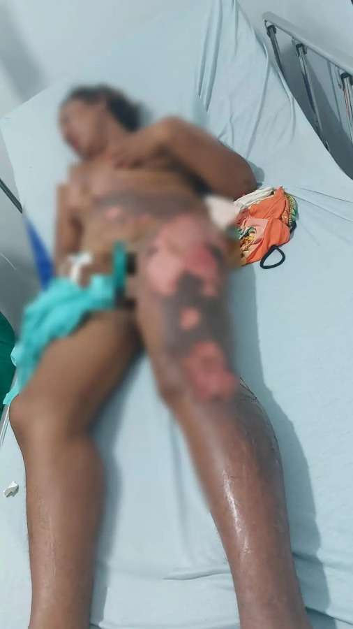 mulher sofre queimadura após marido jogar água quente