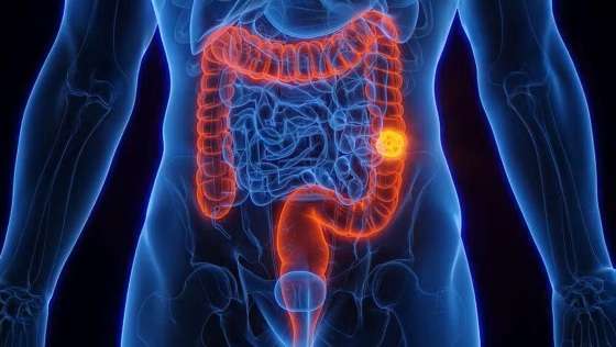 Aumento proporcional de casos de tumor no intestino entre mais jovens chamou a atenção de cientistas.